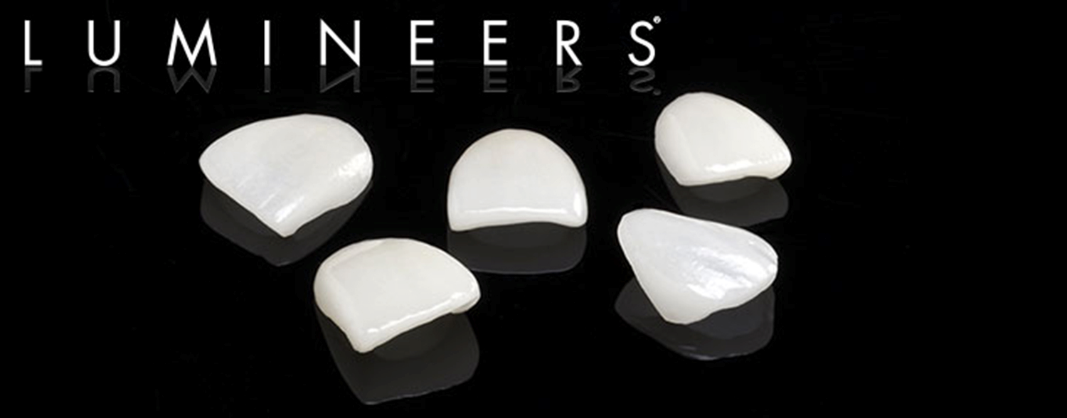 Lumineers 2 | balhannah dental
