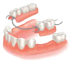 Partial Dentures