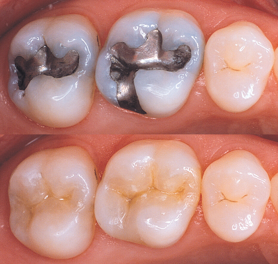 white Filling_BeforeAfter